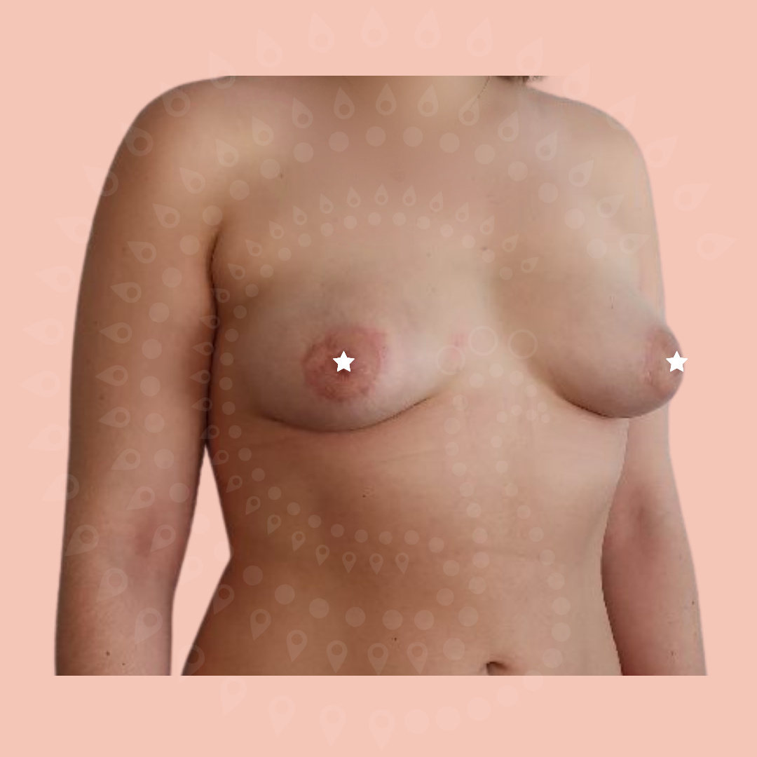 Après une augmentation mammaire par lipofilling par le Docteur Gardeil à Rouen
