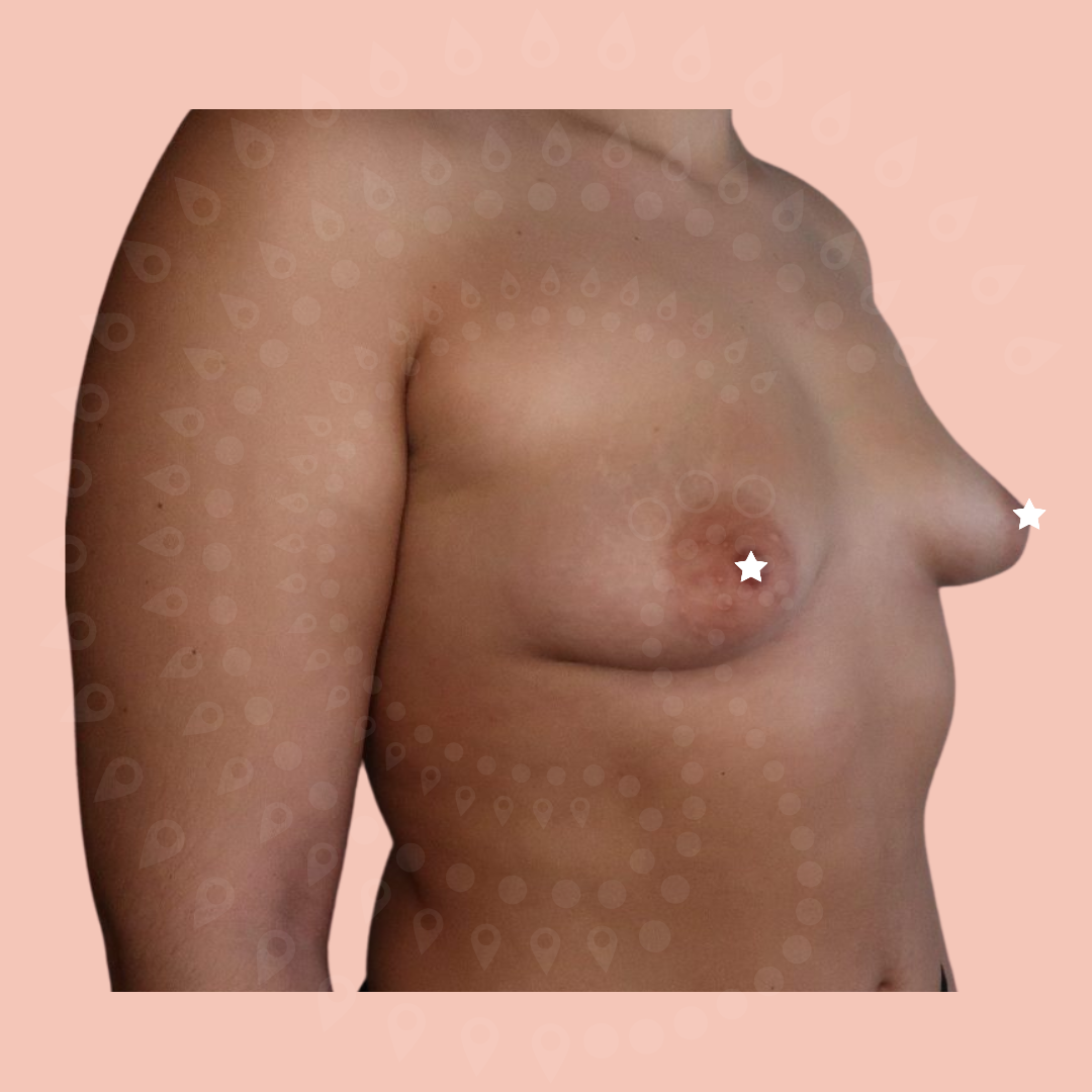 Avant une augmentation mammaire par lipofilling par le Docteur Gardeil à Rouen